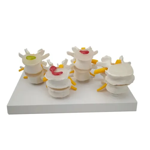 4-Stage Pathological Human Lumbar Spine Anatomy Model - Detailed Medical Teaching Tool for Spine Study [Lumbar Spine Model, Anatomy Teaching, Medical Education]