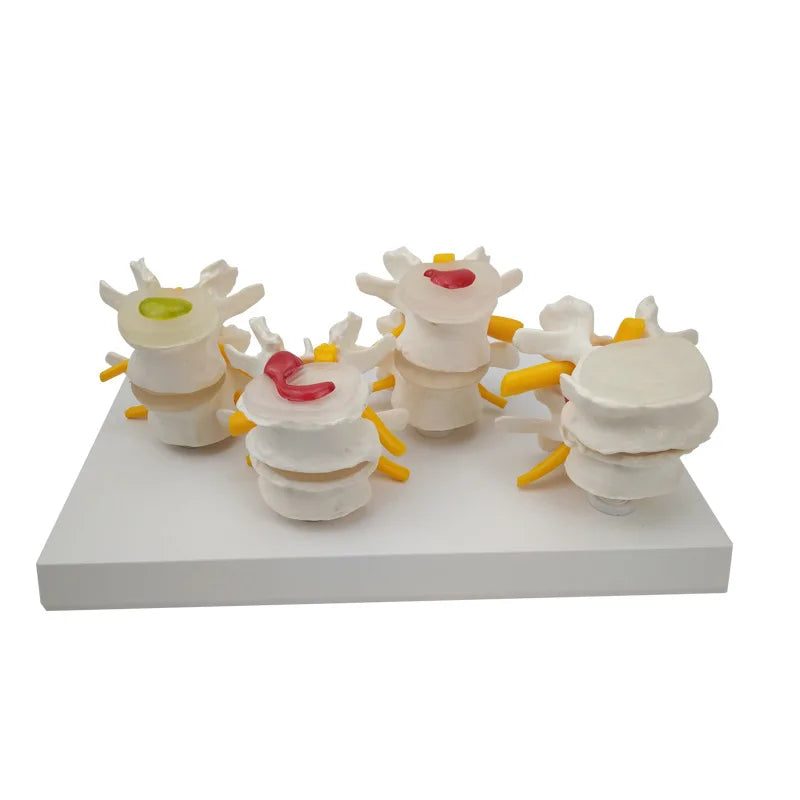 4-Stage Pathological Human Lumbar Spine Anatomy Model - Detailed Medical Teaching Tool for Spine Study [Lumbar Spine Model, Anatomy Teaching, Medical Education]