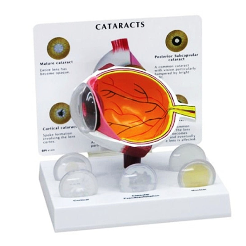 4X Human PVC Eye Cataract Anatomy Teaching Model - Detailed Eye Structure & Cataract Types for Medical Education