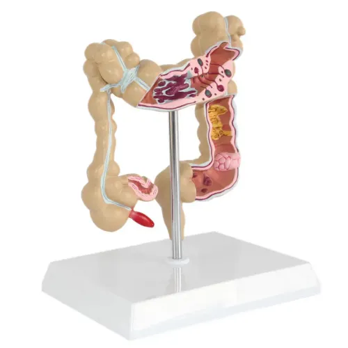 Anatomical Human Colorectal Lesion Model - Detailed Colon Disease Anatomy for Medical Teaching & Learning