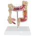 Anatomical Human Colorectal Lesion Model - Detailed Colon Disease Anatomy for Medical Teaching & Learning