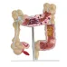 Anatomical Human Colorectal Lesion Model - Detailed Colon Disease Anatomy for Medical Teaching & Learning