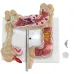 Anatomical Human Colorectal Lesion Model - Detailed Colon Disease Anatomy for Medical Teaching & Learning