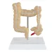 Anatomical Human Colorectal Lesion Model - Detailed Colon Disease Anatomy for Medical Teaching & Learning