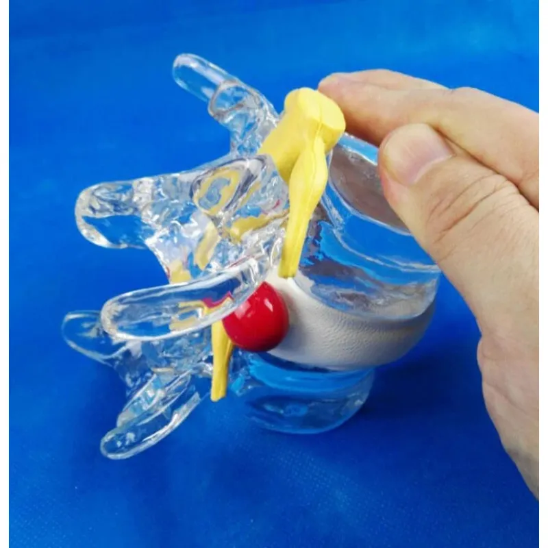 Anatomical Lumbar Vertebrae Model - Degenerative Disc Herniation & Spine Anatomy Demonstration [Medical Education, Spine Model]