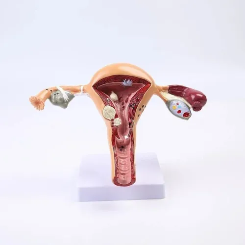 Anatomical Pathological Uterus Ovary Model - Life Size Female Reproductive System Study Tool [Medical, Anatomy, Cross Section]
