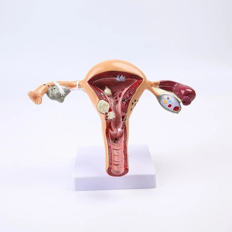 Anatomical Pathological Uterus Ovary Model - Life Size Female Reproductive System Study Tool [Medical, Anatomy, Cross Section]