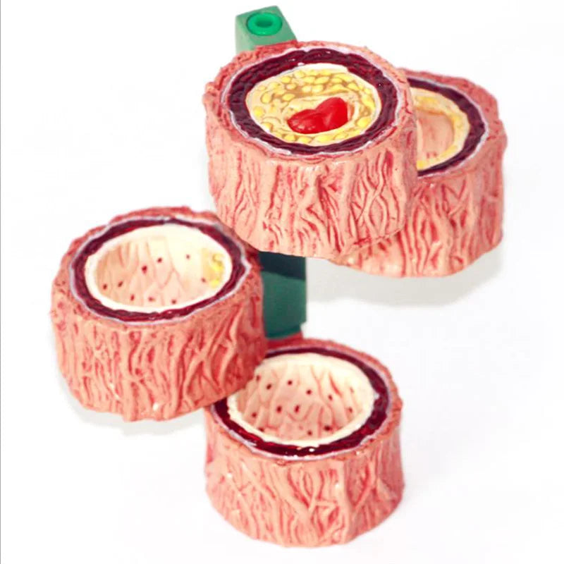 Human Artery Model - 4 Stages of Arteriosclerosis Anatomy Model for Medical Teaching & Learning [Arteriosclerosis, Anatomy Model]
