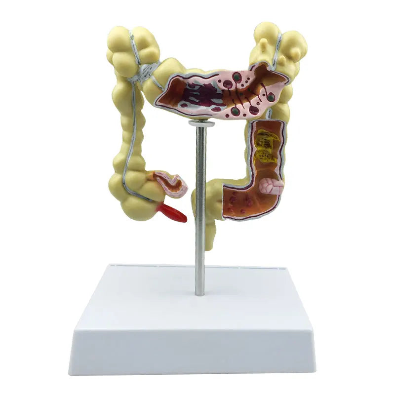 Colorectal Lesion Model - Human Colon Anatomy Pathological Diseases Model for Medical Education [Colon Model, Pathology, Medical Anatomy]