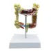 Colorectal Lesion Model - Human Colon Anatomy Pathological Diseases Model for Medical Education [Colon Model, Pathology, Medical Anatomy]