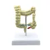 Colorectal Lesion Model - Human Colon Anatomy Pathological Diseases Model for Medical Education [Colon Model, Pathology, Medical Anatomy]