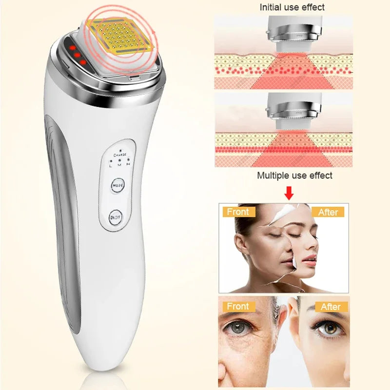 RF Facial Lifting Machine - Skin Tightening, Wrinkle Removal & Rejuvenation with Dot Matrix Technology