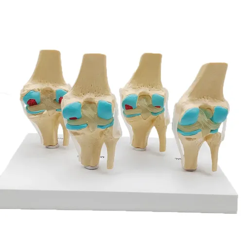 Four-Stage Human Pathological Knee Joint Anatomy Model - Medical Teaching Tool [Knee Anatomy, Pathology Model]