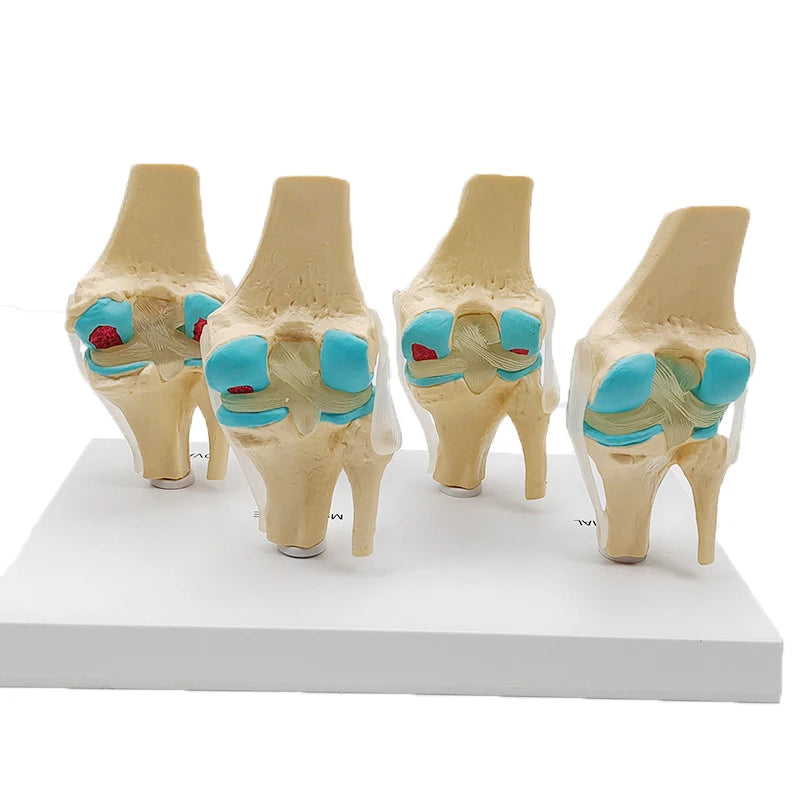 Four-Stage Human Pathological Knee Joint Anatomy Model - Medical Teaching Tool [Knee Anatomy, Pathology Model]
