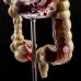 Human Colorectal Lesion Model - Pathological Anatomy Colon Diseases Intestine Medical Teaching Tool [Colorectal Lesion, Medical Teaching]