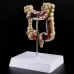 Human Colorectal Lesion Model - Pathological Anatomy Colon Diseases Intestine Medical Teaching Tool [Colorectal Lesion, Medical Teaching]