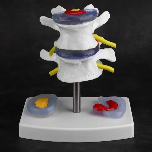 Intervertebral Disc Herniation Model - Lumbar Spine Pathology Teaching Tool for Medical Education [Spine Model, Herniated Disc, Medical Teaching]