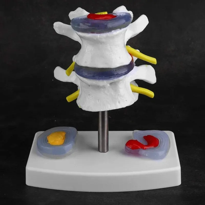 Intervertebral Disc Herniation Model - Lumbar Spine Pathology Teaching Tool for Medical Education [Spine Model, Herniated Disc, Medical Teaching]