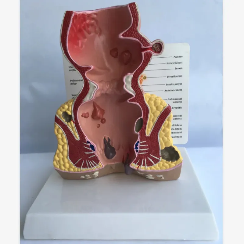 Rectum Anatomical Model with Pathologies - 1.5x Life Size, PVC Material, Detailed Description Plate [Rectum Model, Anatomical Model]