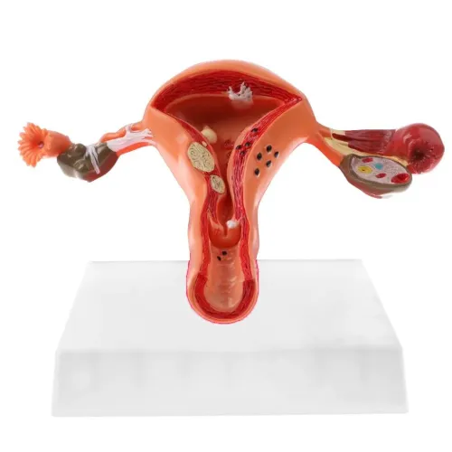 1:1 Lifesize Female Uterus Ovary Pathology Model - Anatomical Teaching Aid for Medical Study [Uterus Model, Pathology Display, Medical Anatomy]
